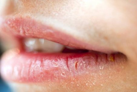 چرا گوشه لب‌ها ترک می‌خورد؟