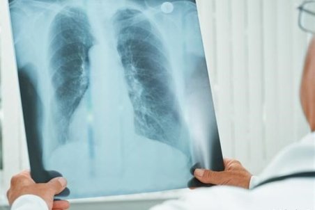 آمبولی ریوی چیست و چه علائمی دارد؟