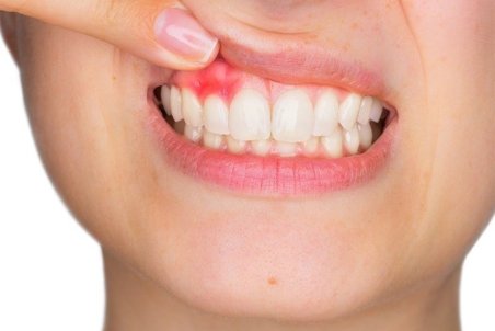 "خونریزی لثه" را جدی بگیرید! + راهکارهای درمانی طب سنتی