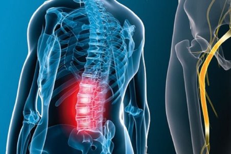 علت اصلی درد سیاتیک چیست؟