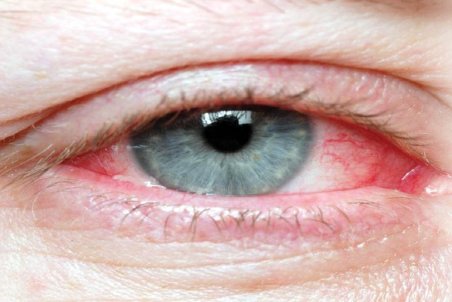 آشنایی با عوامل ایجاد کننده خشکی چشم