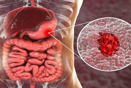 علائم ابتلا به زخم معده