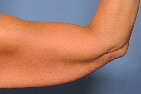 رفع شلی بازو؛ چند ورزش آسان