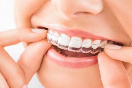 سن طلایی برای ارتودنسی /چگونه بفهمیم به ارتودنسی نیاز داریم؟