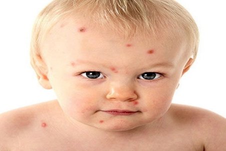 بیماری شینگلز چیست؟