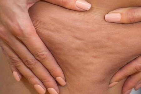 سلولیت یا عفونت بافت همبند چیست؟