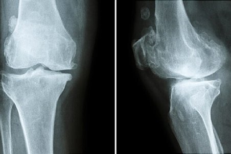 عوارض کمبود کلسیم برای بدن