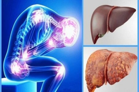 یک روش ساده گیاهی برای درمان «کبد چرب»