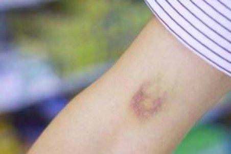 بدن شما هم بی علت کبود می شود ؟