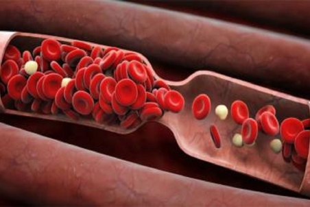 علایم وجود لخته خون خطرناک در بدن