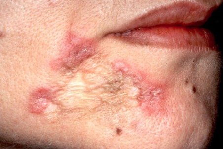 لوپوس چیست؟ + بررسی خطر ابتلا