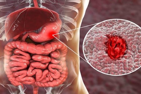 علائم و عوارض زخم‌های گوارشی را جدی بگیرید!