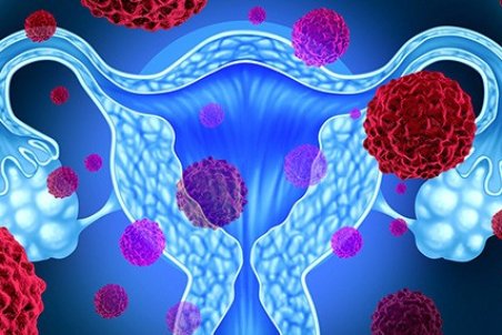 اندومتریوز؛ هر آنچه که باید درباره آن بدانید