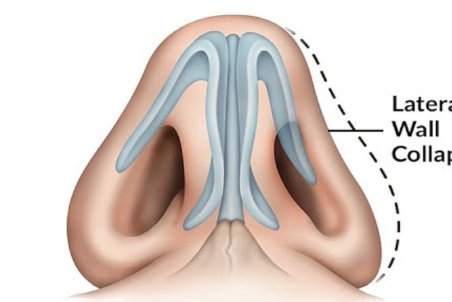 علائم و علل افتادگی دریچه بینی