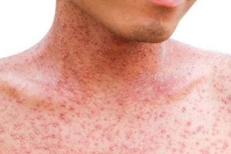 سرخک؛ مسری‌ترین بیماری عفونی/ هر بیمار ۱۸ نفر را درگیر می‌کند