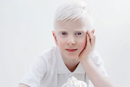 آلبینیسم یا زالی؛ علائم، علل، عوارض و انواع آن