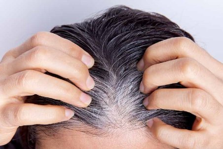 نسخه‌های طبیعی برای درمان ریزش و سفیدی مو