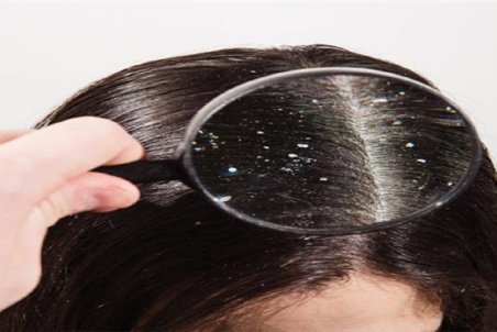 شوره سر؛ نشانه‌ای از یک بیماری عصبی