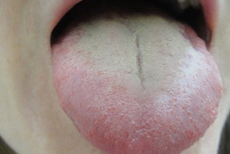 سفید شدن زبان زنگ خطر این بیماری‌هاست!