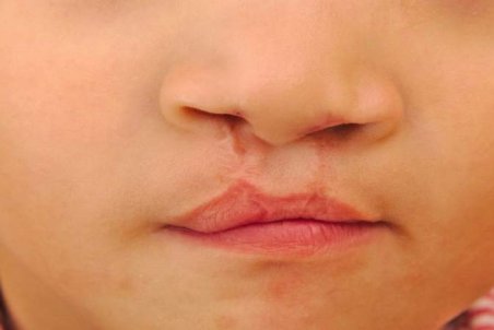 از دلایل تا راه درمان شکاف لب و کام