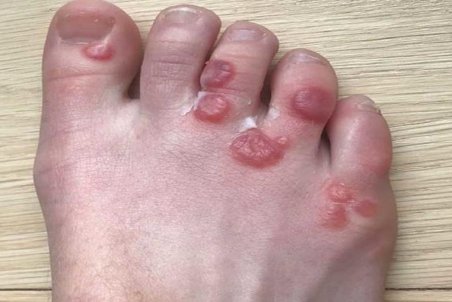 چگونه تاول خونی پا را درمان کنیم؟