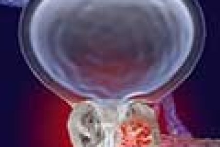 سرطانی که در مردان ایرانی زیاد است