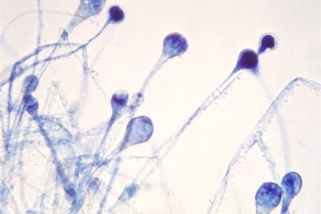 آنچه باید از "قارچ سیاه" بدانید/ چه کسانی بیشتر در معرض خطر ابتلا قرار دارند؟