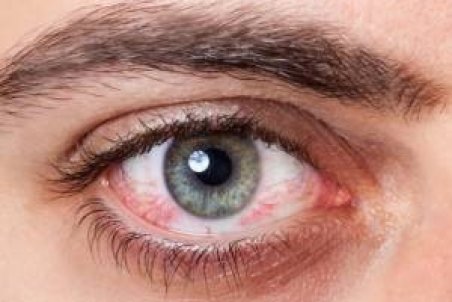 جلوی حساسیت و قرمزی چشم ها را بگیرید