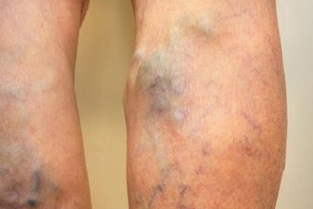 علائم لخته شدن خون در بدن چیست؟