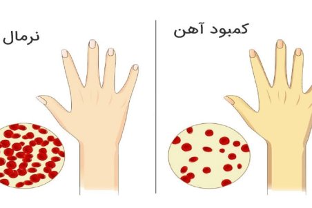 بارزترین نشانه‌های کمبود آهن و روش بالا بردن آهن خون