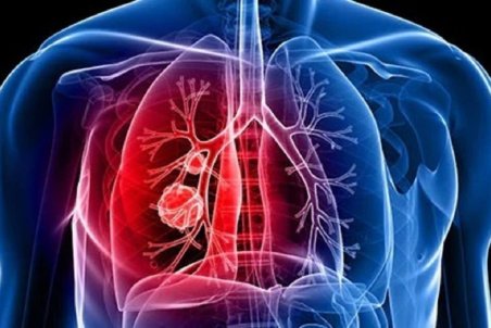 علائم غیرمنتظره سرطان ریه