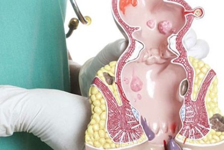 علائم، دلایل و راه‌های درمان یبوست