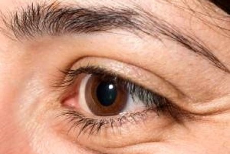 علل پف چشم و روش های درمان آن