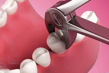 عوارض نکشیدن دندان عقل نهفته