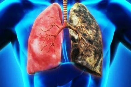 سرطان ریه؛ مهمان ناخوانده‌ سینه