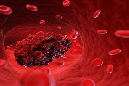 علائم اولیه لخته شدن خون؛ ۱۰ نشانه که اصلا نباید نادیده بگیرید