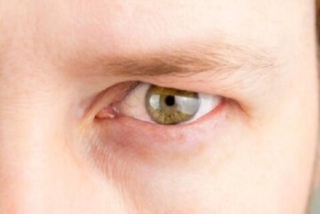 درمان افتادگی پلک در طب سنتی و اسلامی