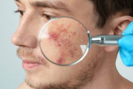 توصیه‌های مهم برای جلوگیری از آفتاب سوختگی