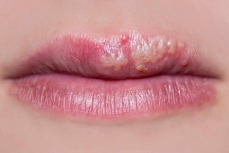 ساده‌ترین راهکار‌های خانگی برای درمان تبخال