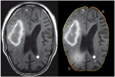 کرونای دلتا ظاهری گول‌زننده دارد/برای سی‌تی‌اسکن ریه منتظر سرفه و تنگی نفس نباشید