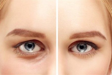 درمانی برای خواباندن پف چشم