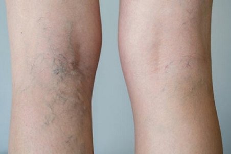 عادت‌های غلطی که نمی‌دانستید باعث واریس می‌شوند