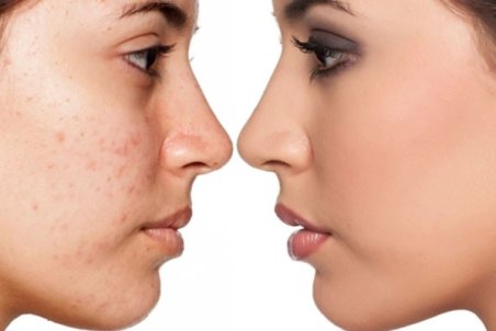 از بین بردن جای جوش با بهترین روش‌های خانگی