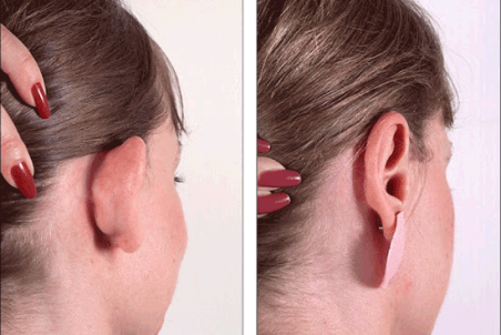 جراحی زیبایی گوش یا اتوپلاستی