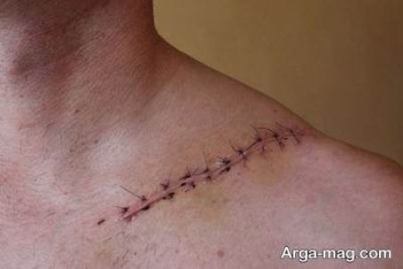 درمان عفونت بخیه و پیشگیری از عفونی شدن