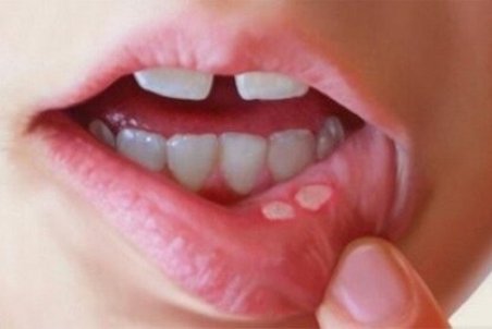 هر آنچه باید درباره آفت دهان بدانید