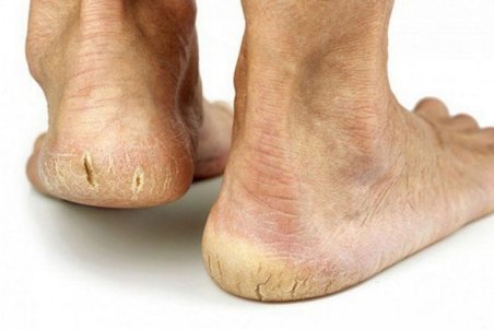 اصلی‌ترین دلایل بروز ترک پاشنه پا