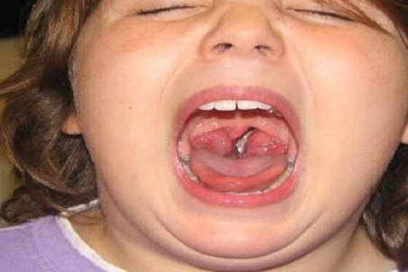 درباره عوامل ابتلا به التهاب لوزه و درمان آن بیشتر بدانید