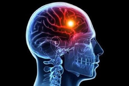 هنگام سکته مغزی پیش از رسیدن اورژانس چه کنیم؟