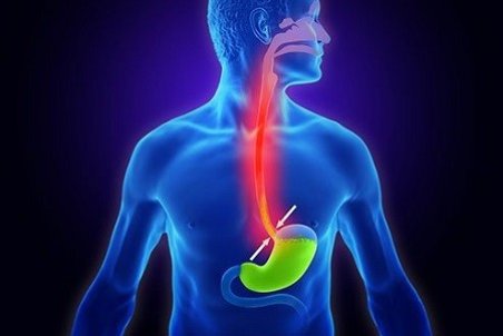 علائم و نشانه‌های رفلاکس معده